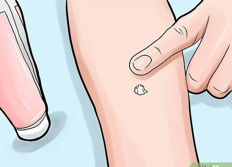 шаг 5успокойте место укуса, нанеся на него каламиновый лосьон или безрецептурный препарат, предназначенный для лечения укусов насекомых.