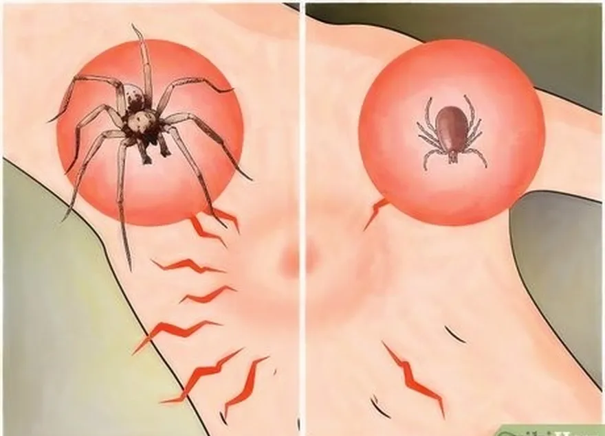 шаг 3 дон't confuse tick bites as spider bites.