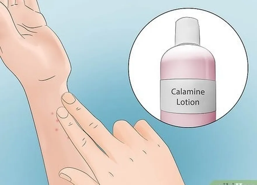 шаг 2 нанесите немного каламинового лосьона или гидрокортизонового крема.